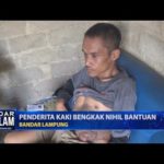 Penderita Kaki Bengkak Nihil Bantuan