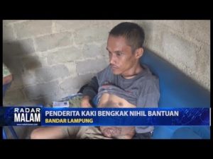 Penderita Kaki Bengkak Nihil Bantuan